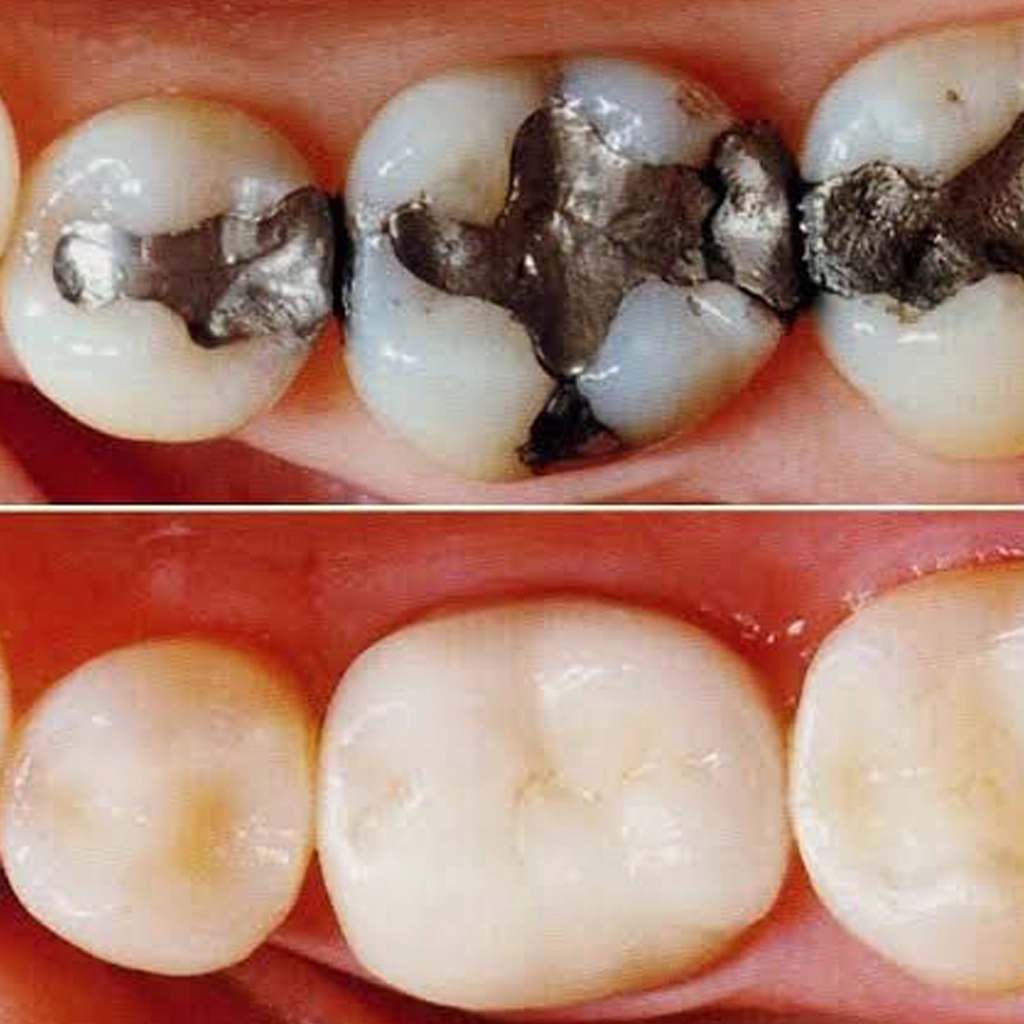 Composite Filling Treatment