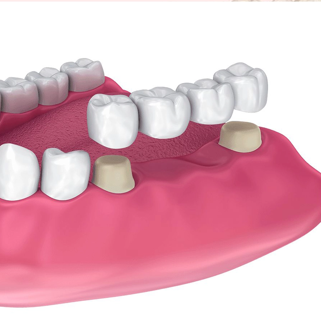 Crowns and Bridges Treatment