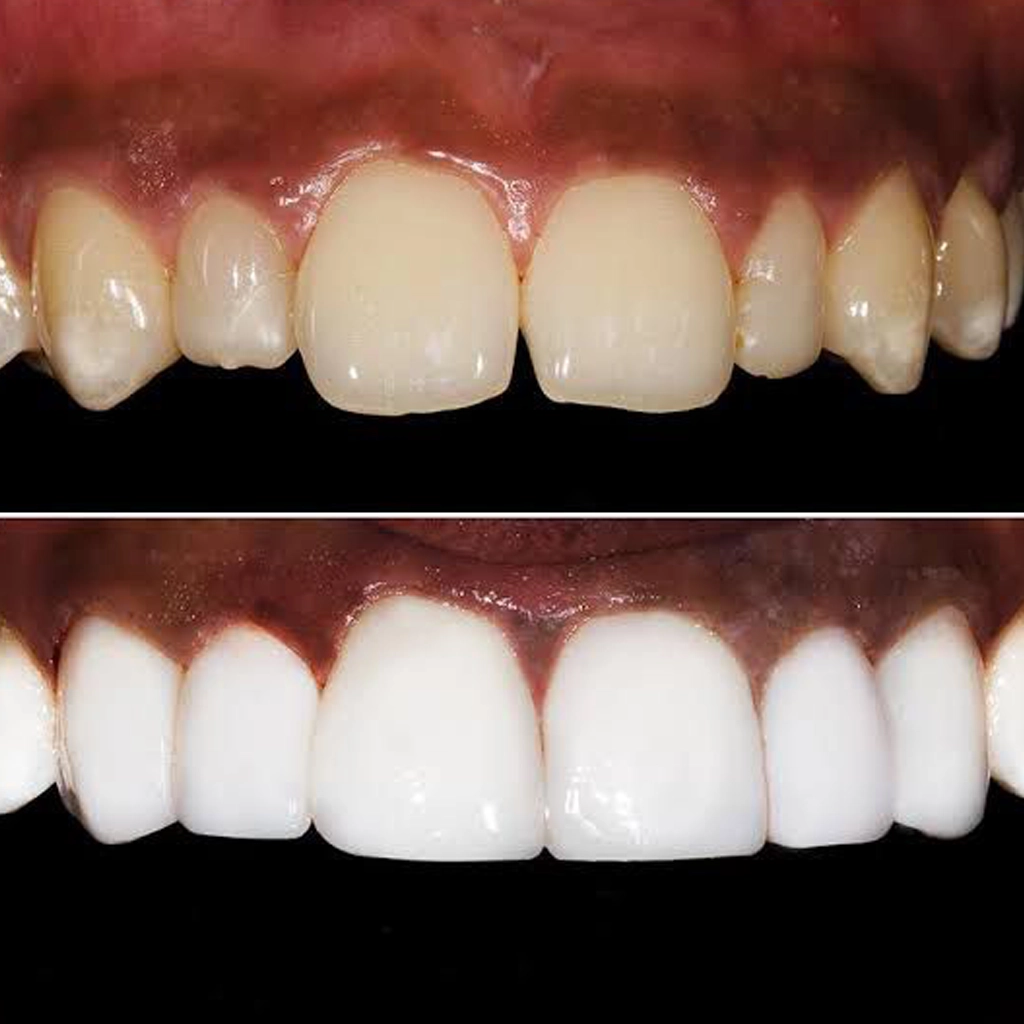 Laminate Veneer Treatment