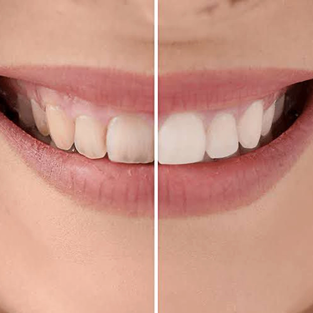 Pink Esthetics Treatment