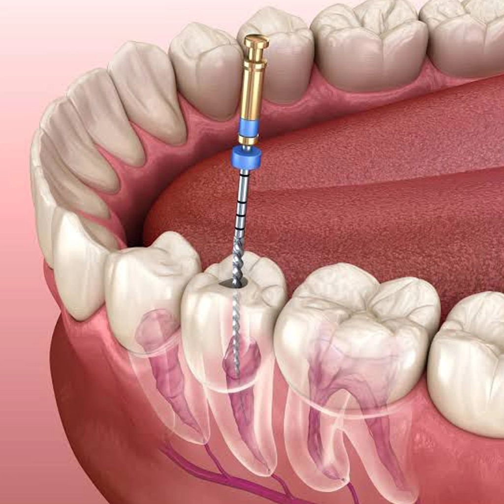 Root Canal Treatment