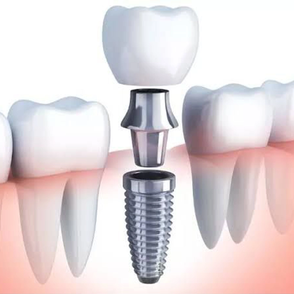 Dental Implant