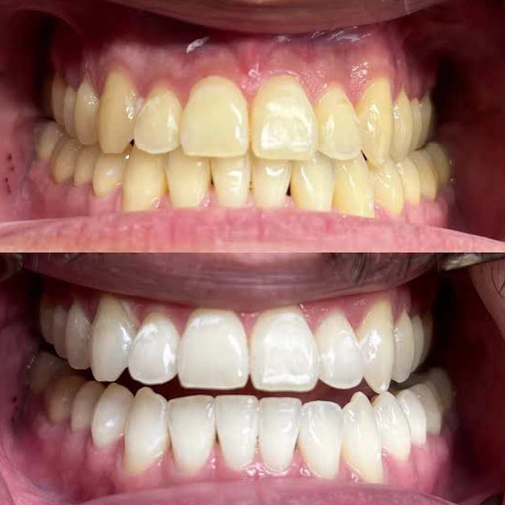 Teeth Whitening Treatment